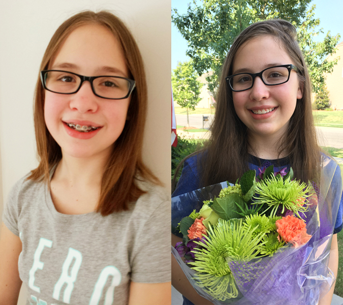 Emily-Braces.jpg